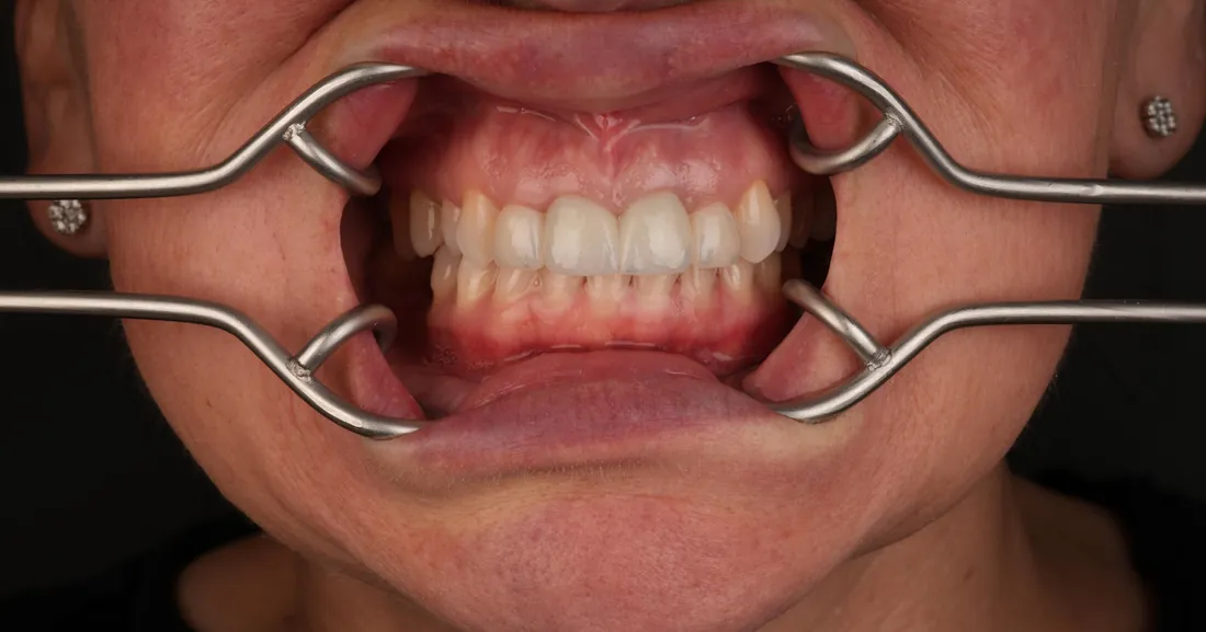 Smile after treatment, case 01