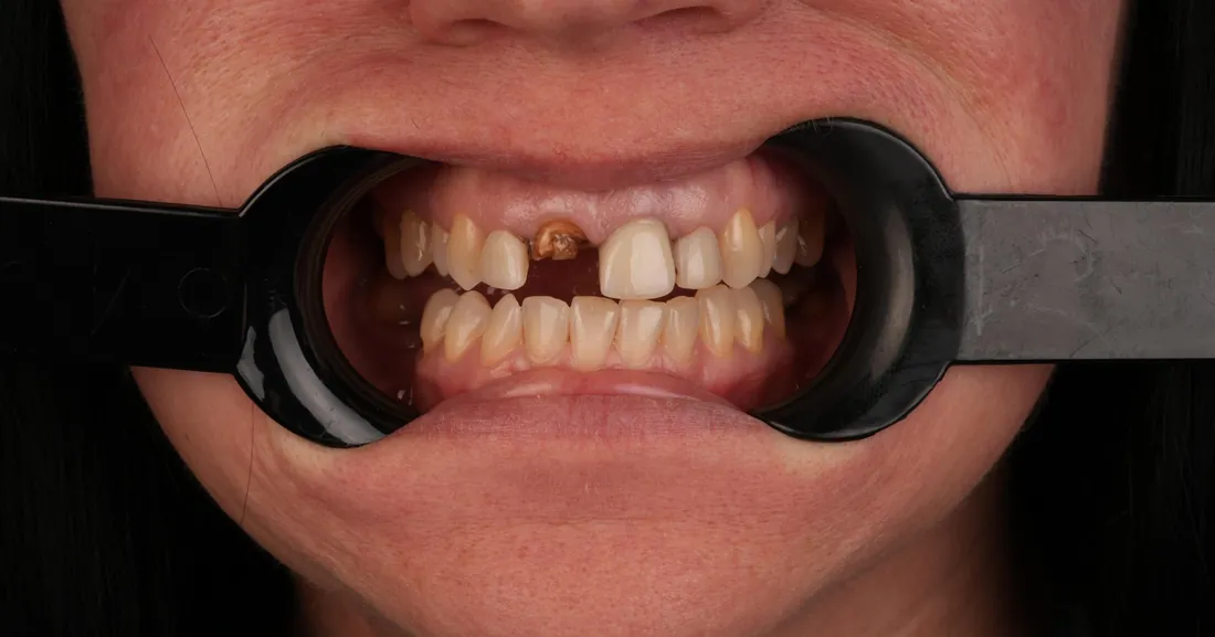 Smile before treatment, case 01