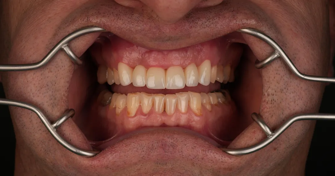 Smile after treatment, case 02