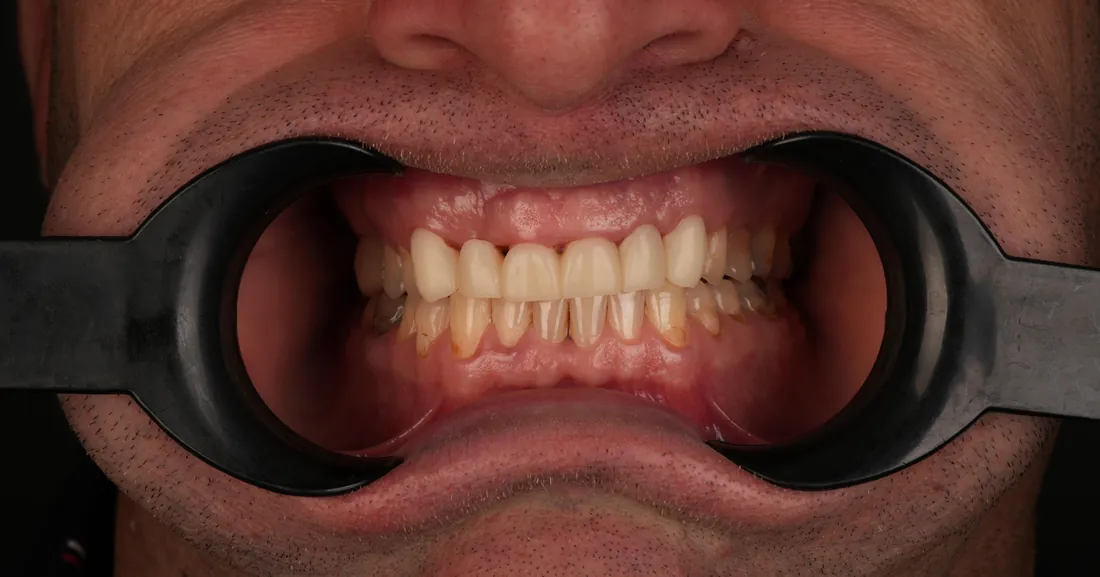 Smile before treatment, case 02
