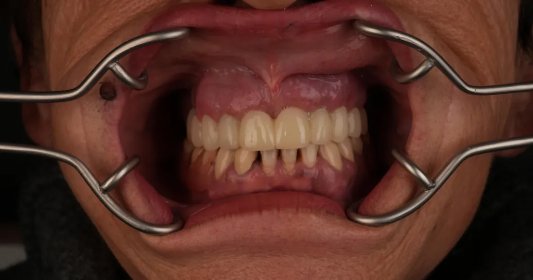 Smile after treatment, case 03