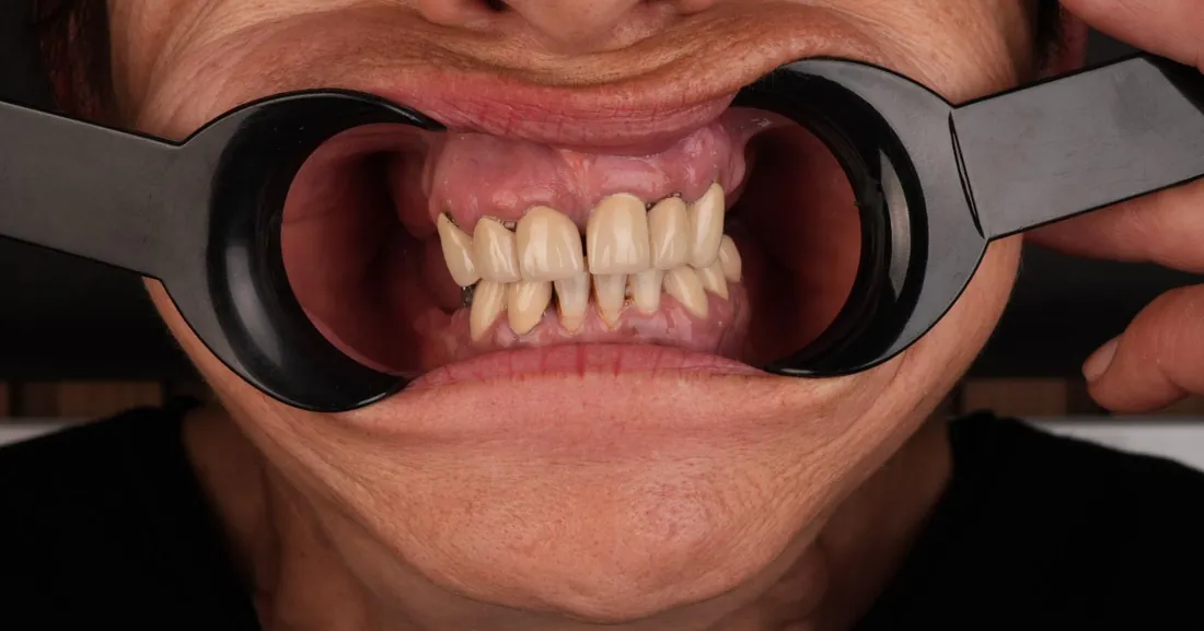 Smile before treatment, case 03