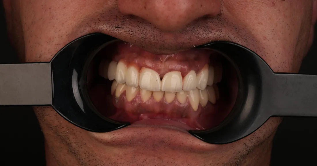 Smile after treatment, case 04