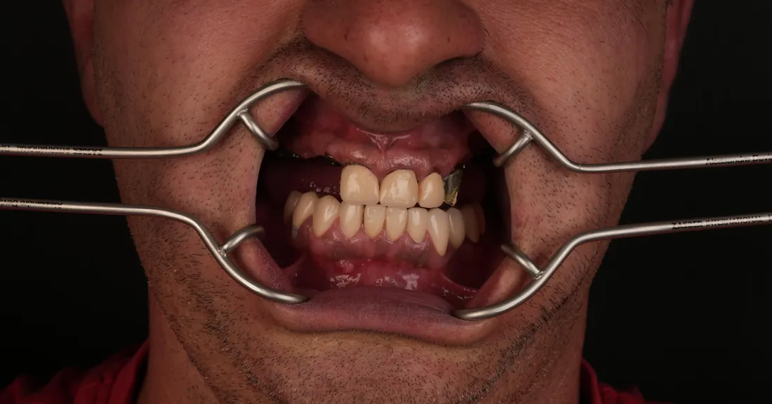 Smile before treatment, case 04