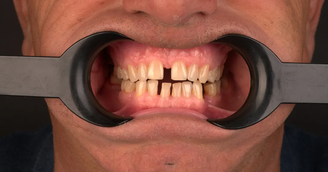 Smile before treatment, case 05