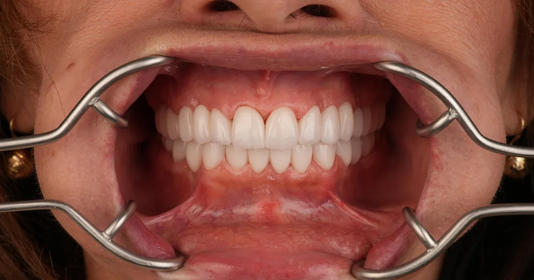 Smile after treatment, case 06