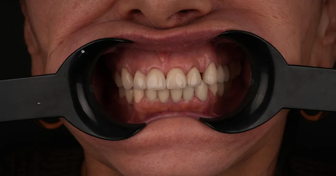 Smile before treatment, case 06